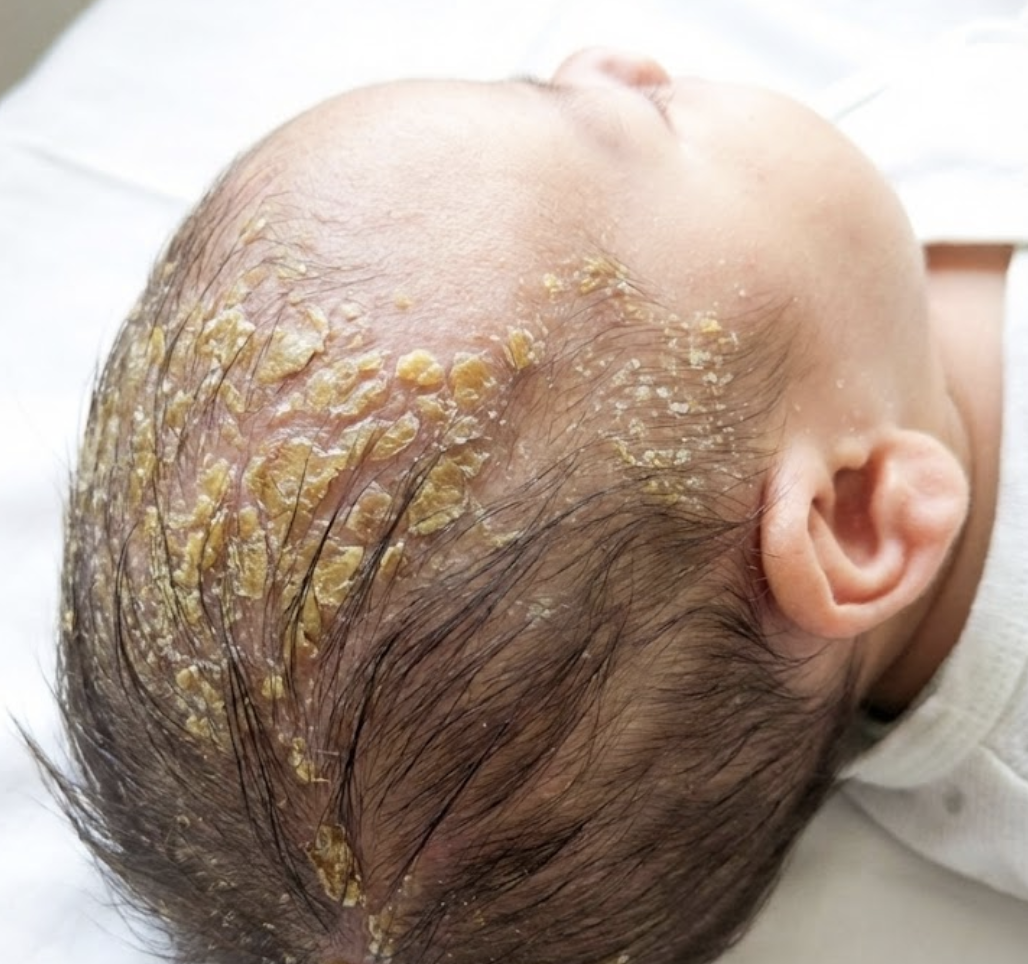 脂漏性湿疹の赤ちゃんの頭