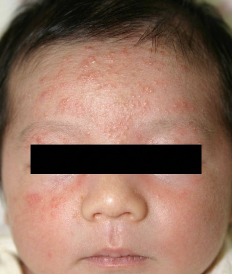 乳児アトピー性皮膚炎、顔面の写真
