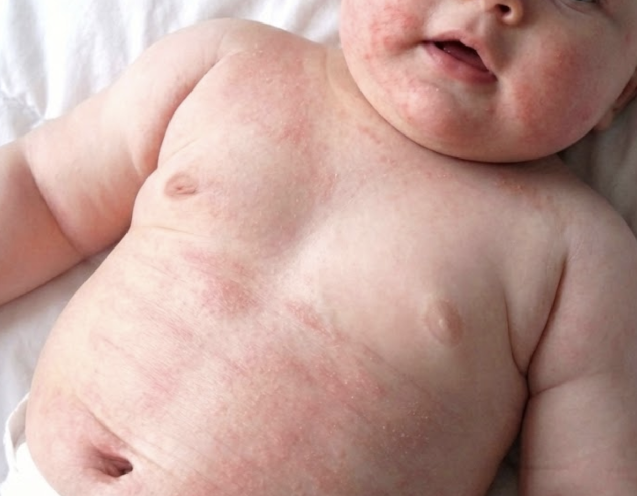 乳児アトピー性皮膚炎の病変写真