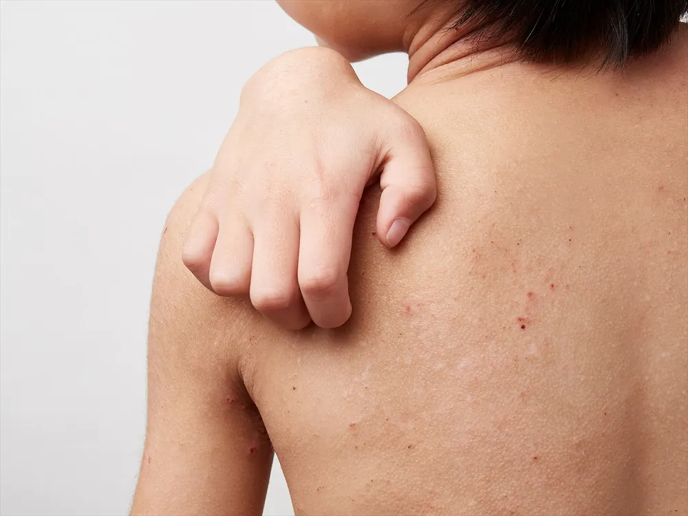 アトピー性皮膚炎って何でしょう？